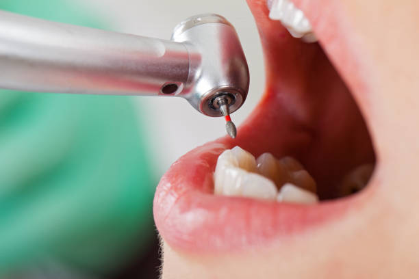 Best Emergency Tooth Extraction in Mercedes, TX